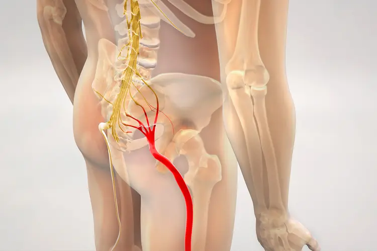 Sciatica: Going Beyond Common Myths And The Roadmap To Relief