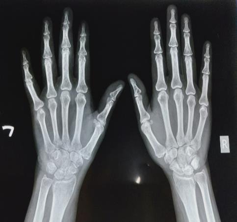 Complex Regional Pain Syndrome and it’s management